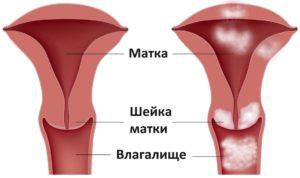 эрозия шейки матки лечение