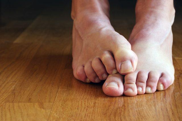 причины онемения пальцев ног