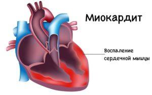 миокардит у детей симптомы