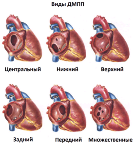 дефект межпредсердной перегородки сердца