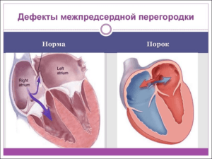 дефект межпредсердной перегородки у детей