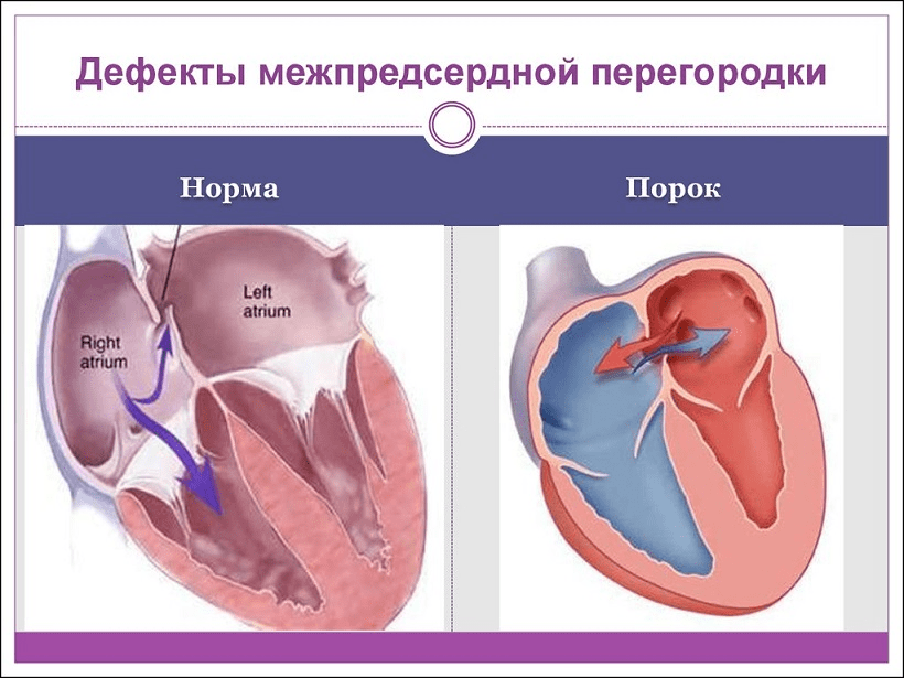 Для аускультативной картины дмпп характерно