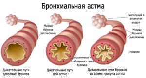 бронхиальная астма симптомы