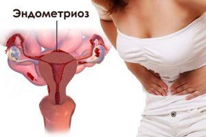 эндометриоз симптомы и лечение